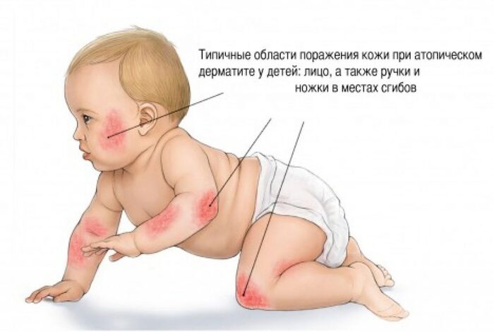 Атопический дерматит (Atopic dermatitis)