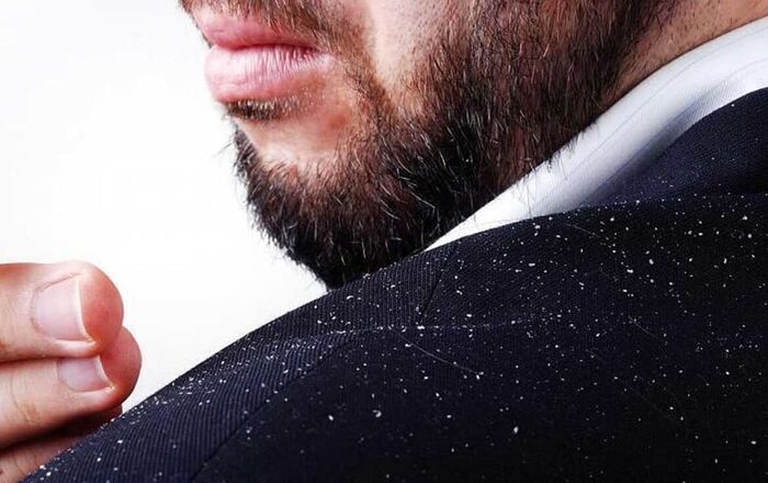 Перхоть, себорея